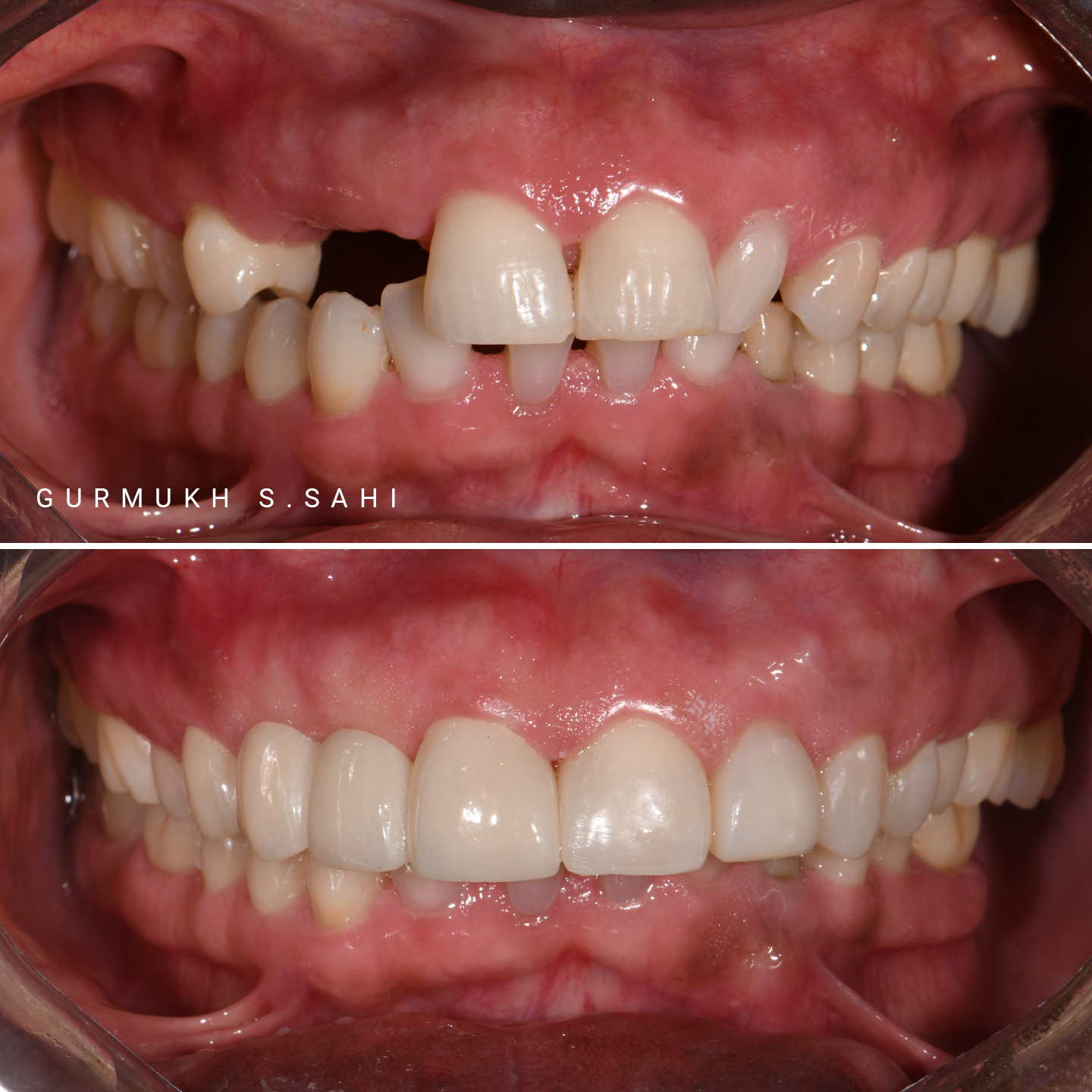 Making a patient smile with diastema closure. A minimally invasive approach  